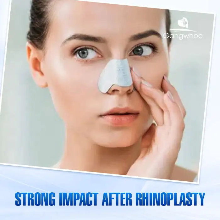 Is Nasal Swelling After 1 Year of Rhinoplasty Dangerous? How Should It Be Treated? 2 Is Nasal Swelling After 1 Year of Rhinoplasty Dangerous? How Should It Be Treated?