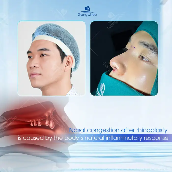 What causes nasal congestion after rhinoplasty? How should it be managed?