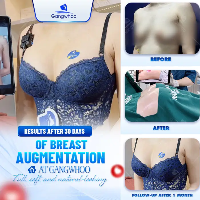 How Much Does Non-Surgical Breast Augmentation Cost? Latest 2025 Price List