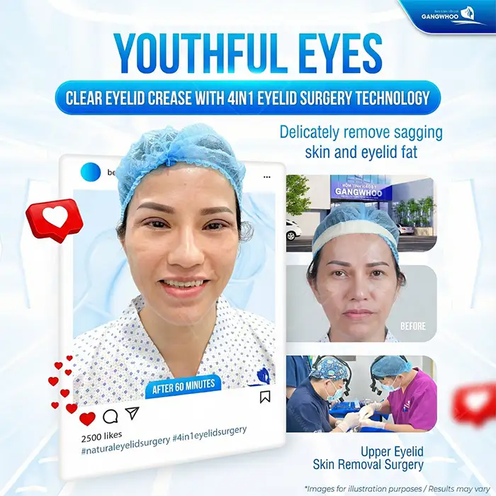 Should protruding eyes undergo double eyelid surgery? Will it affect the eyes?