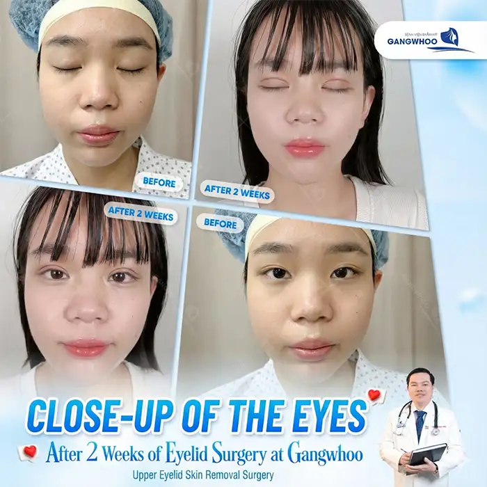 Should protruding eyes undergo double eyelid surgery? Will it affect the eyes?