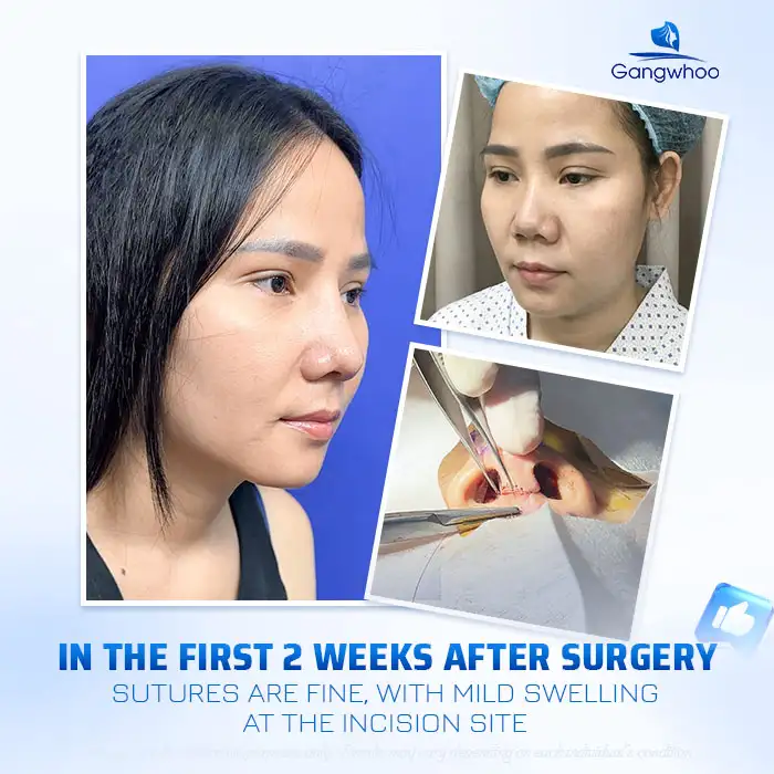 Will the Sutures Be Visible After Rhinoplasty? How to Care for Proper Wound Healing