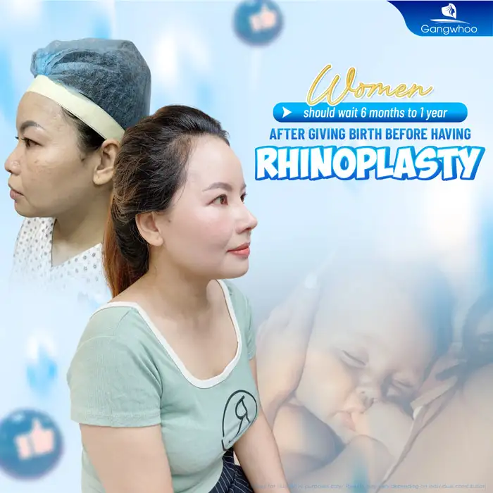 How Long After Childbirth Can You Have Rhinoplasty? Is It Possible to Have Rhinoplasty Immediately After Giving Birth?