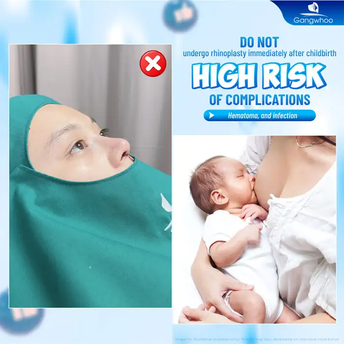 How Long After Childbirth Can You Have Rhinoplasty? Is It Possible to Have Rhinoplasty Immediately After Giving Birth?