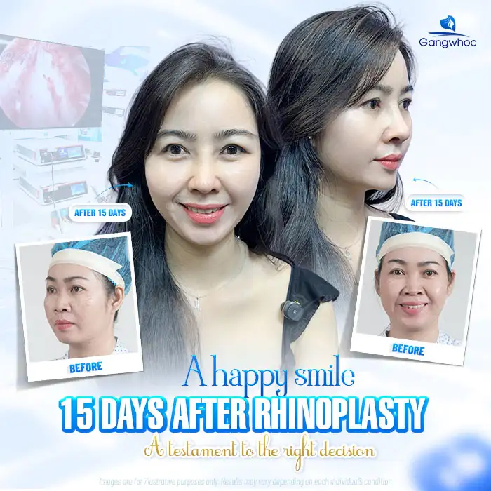 3D nose implant cartilage: is it good? Should you use 3D nose implant cartilage?