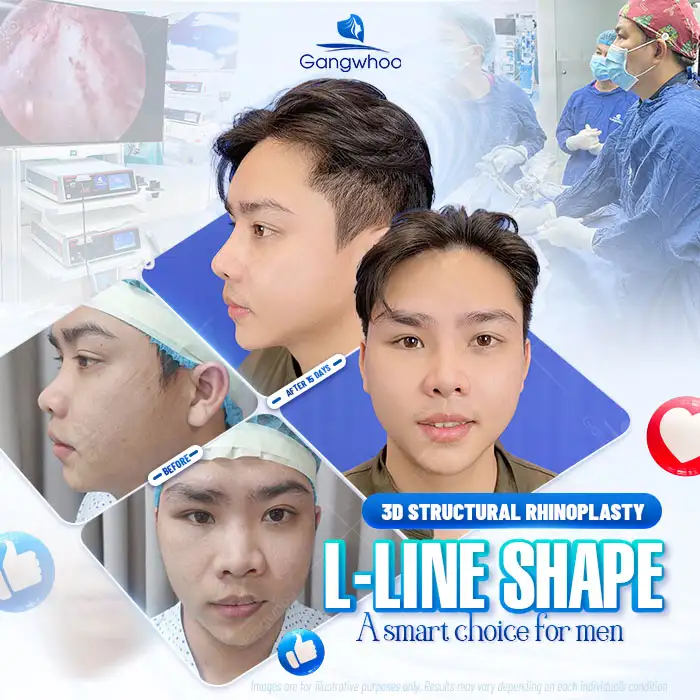 3D nose implant cartilage: is it good? Should you use 3D nose implant cartilage?