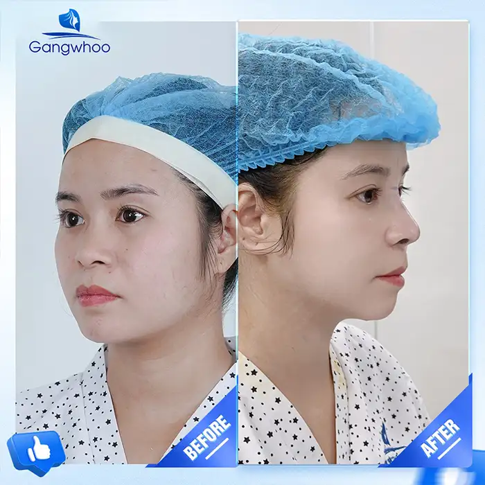 Is Korean Nose Implantation Good? Should You Choose It?