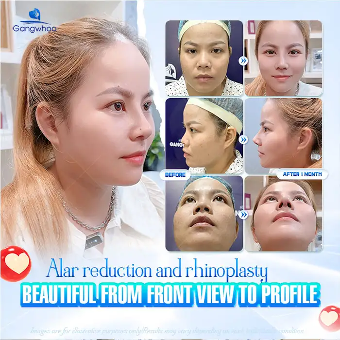 What are the methods of alar reduction and rhinoplasty? Should they be performed at the same time?