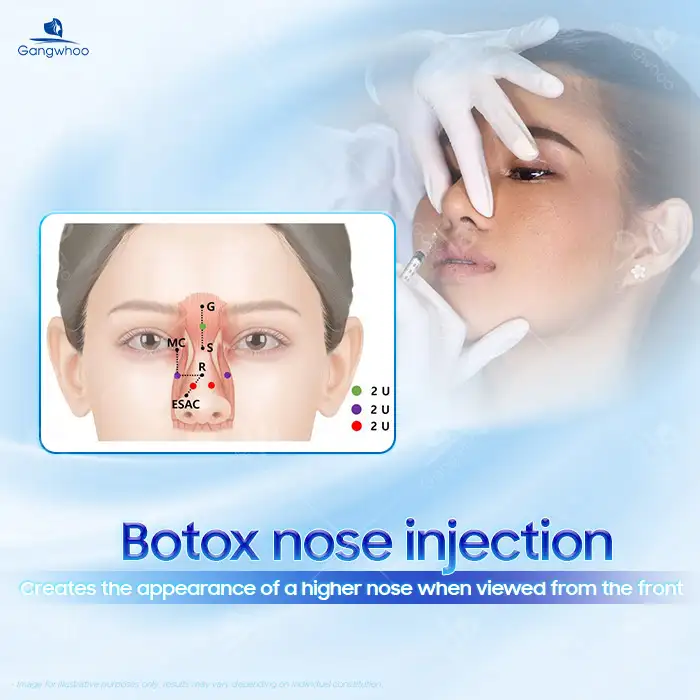 What is Botox nasal lifting? Should you choose the Botox nose lift method? 1 What is Botox nasal lifting? Should you choose the Botox nose lift method?
