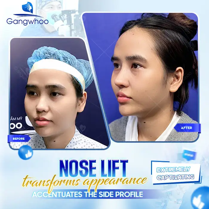 What is Botox nasal lifting? Should you choose the Botox nose lift method? 4 What is Botox nasal lifting? Should you choose the Botox nose lift method?