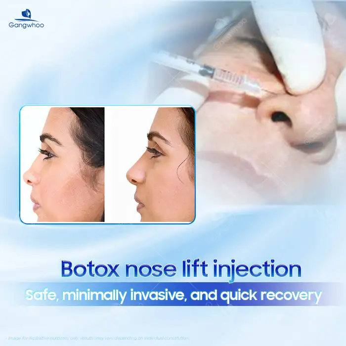 What is Botox nasal lifting? Should you choose the Botox nose lift method? 2 What is Botox nasal lifting? Should you choose the Botox nose lift method?