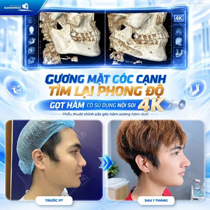 Phẫu Thuật Gọt Hàm V-Line Là Gì? Quy Trình Và Bảng Giá