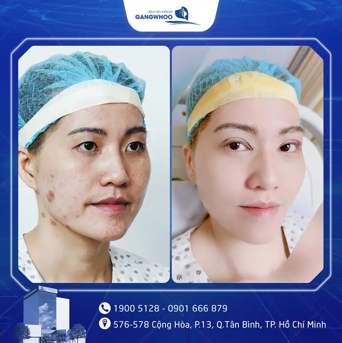 Cắt Mí Mắt Vi Phẫu Là Gì? Giải Pháp Tạo Mí An Toàn, Chuẩn Y Khoa