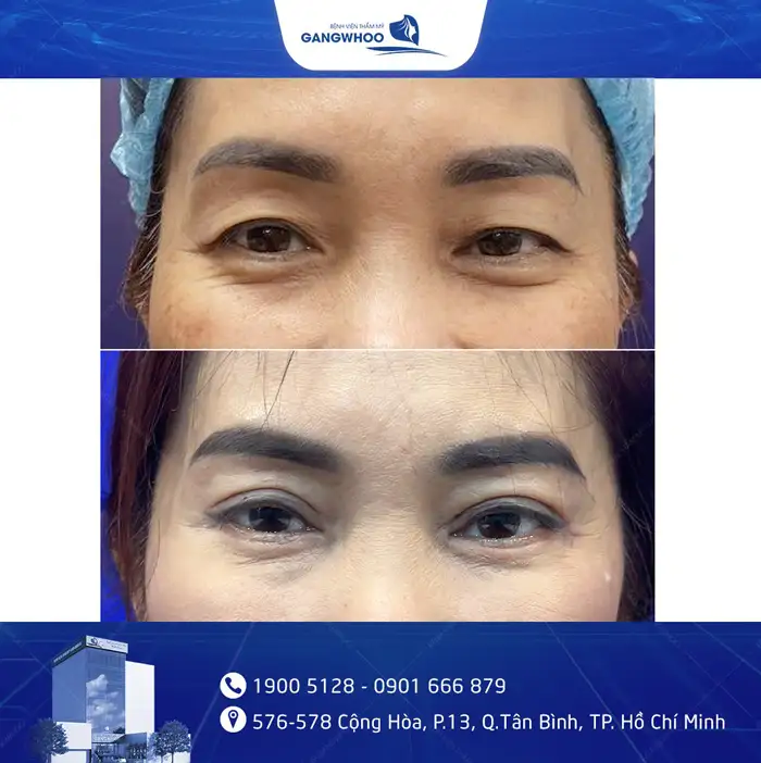 Cắt Mí Mắt Vi Phẫu Là Gì? Giải Pháp Tạo Mí An Toàn, Chuẩn Y Khoa