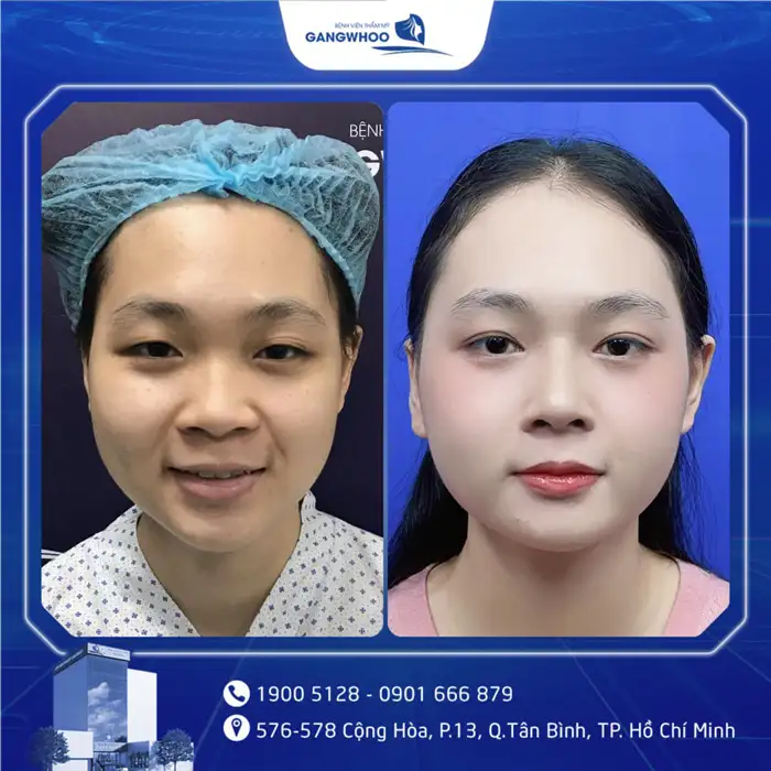 Cắt Mí Mắt Vi Phẫu Là Gì? Giải Pháp Tạo Mí An Toàn, Chuẩn Y Khoa