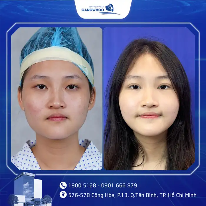 Cắt Mí Mắt Vi Phẫu Là Gì? Giải Pháp Tạo Mí An Toàn, Chuẩn Y Khoa