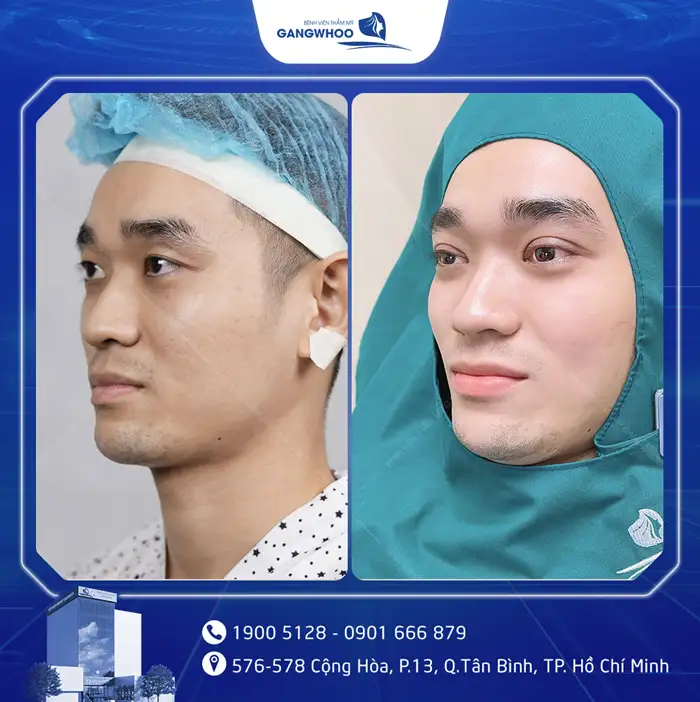 Cắt Mí Mắt Vi Phẫu Là Gì? Giải Pháp Tạo Mí An Toàn, Chuẩn Y Khoa