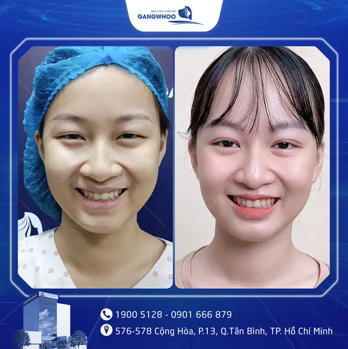 Cắt Mí Mắt Vi Phẫu Là Gì? Giải Pháp Tạo Mí An Toàn, Chuẩn Y Khoa