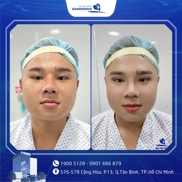 Cắt Mí Mắt Vi Phẫu Là Gì? Giải Pháp Tạo Mí An Toàn, Chuẩn Y Khoa