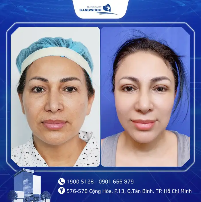 Cắt Mí Mắt Vi Phẫu Là Gì? Giải Pháp Tạo Mí An Toàn, Chuẩn Y Khoa