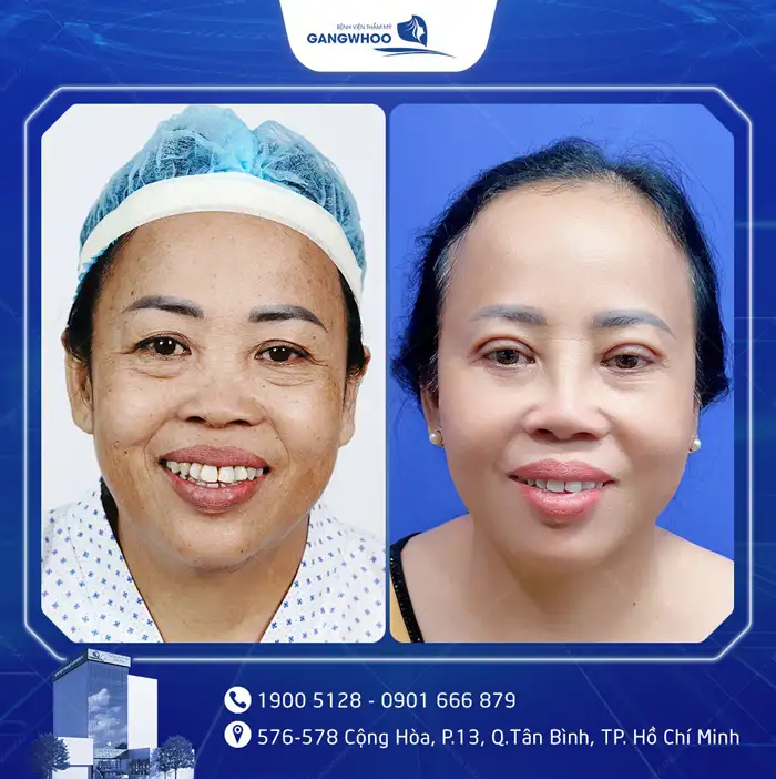 Cắt Mí Mắt Vi Phẫu Là Gì? Giải Pháp Tạo Mí An Toàn, Chuẩn Y Khoa