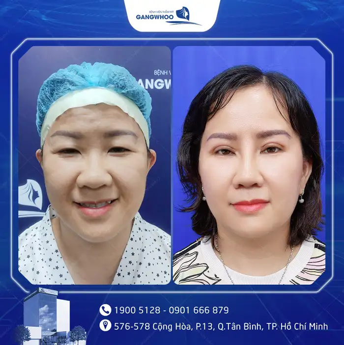 Cắt Mí Mắt Vi Phẫu Là Gì? Giải Pháp Tạo Mí An Toàn, Chuẩn Y Khoa