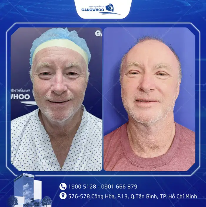 Cắt Mí Mắt Vi Phẫu Là Gì? Giải Pháp Tạo Mí An Toàn, Chuẩn Y Khoa