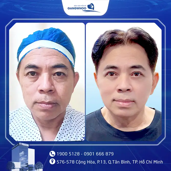 Cắt Mí Mắt Vi Phẫu Là Gì? Giải Pháp Tạo Mí An Toàn, Chuẩn Y Khoa