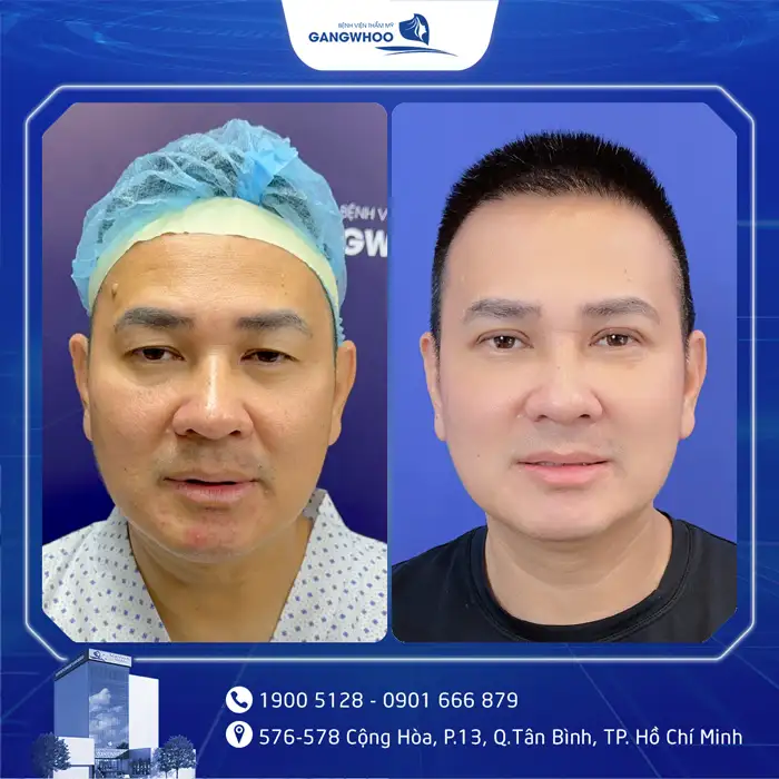 Cắt Mí Mắt Vi Phẫu Là Gì? Giải Pháp Tạo Mí An Toàn, Chuẩn Y Khoa