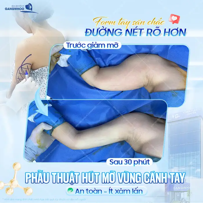 Hút Mỡ Bắp Tay Công Nghệ Cao – Giải Pháp Giúp Tay Thon Gọn An Toàn Tại Gangwhoo