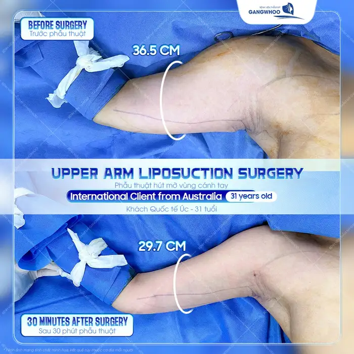 Hút Mỡ Bắp Tay Công Nghệ Cao – Giải Pháp Giúp Tay Thon Gọn An Toàn Tại Gangwhoo