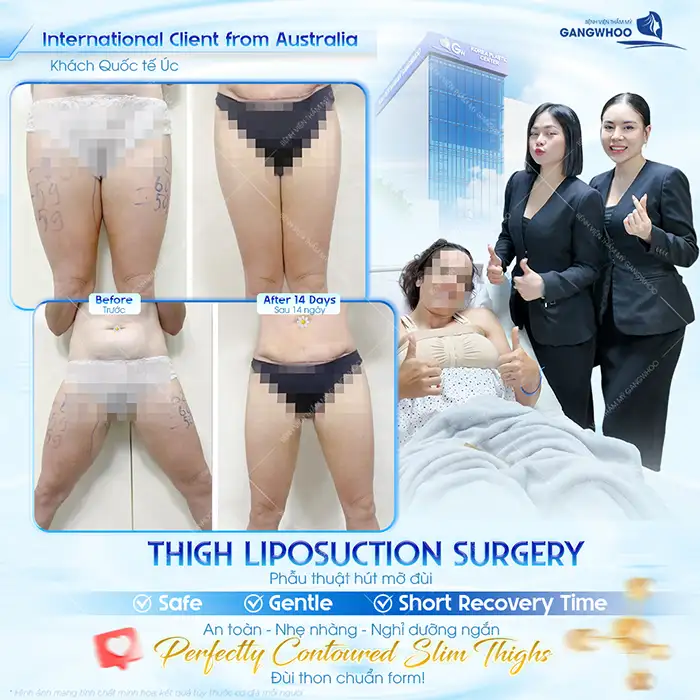 Hút Mỡ Đùi Công Nghệ Lipo Ultrasound – Giải Pháp Giảm Mỡ Đùi An Toàn, Dáng Chân Thon Gọn 2 Hút Mỡ Đùi Công Nghệ Lipo Ultrasound – Giải Pháp Giảm Mỡ Đùi An Toàn, Dáng Chân Thon Gọn