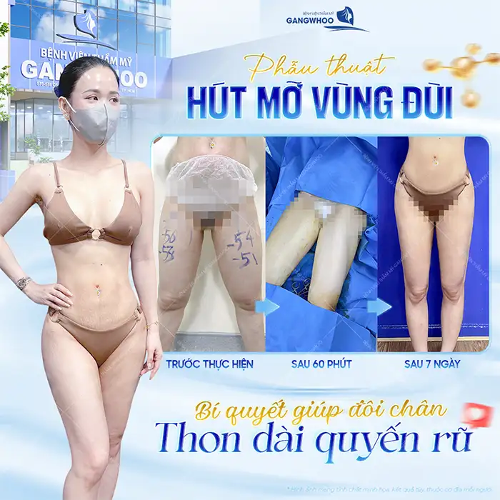 Hút Mỡ Đùi Công Nghệ Lipo Ultrasound – Giải Pháp Giảm Mỡ Đùi An Toàn, Dáng Chân Thon Gọn 3 Hút Mỡ Đùi Công Nghệ Lipo Ultrasound – Giải Pháp Giảm Mỡ Đùi An Toàn, Dáng Chân Thon Gọn