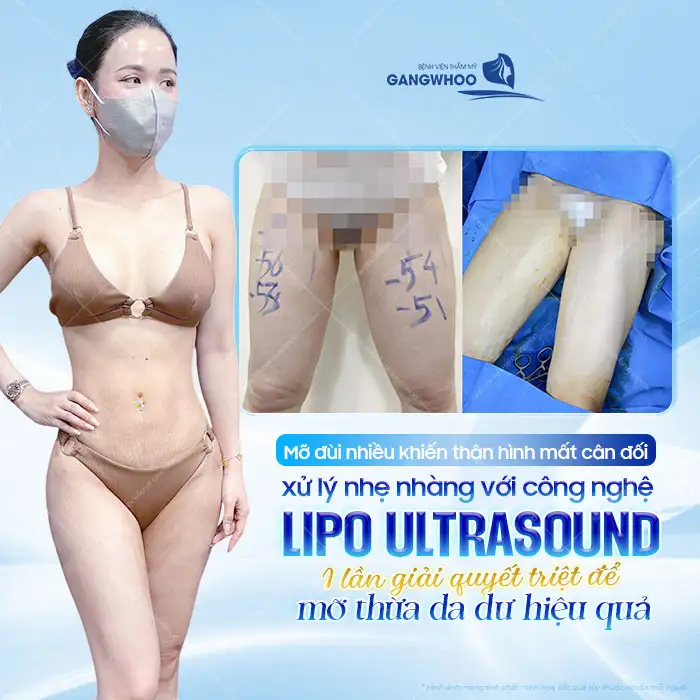 Hút Mỡ Đùi Công Nghệ Lipo Ultrasound – Giải Pháp Giảm Mỡ Đùi An Toàn, Dáng Chân Thon Gọn 1 Hút Mỡ Đùi Công Nghệ Lipo Ultrasound – Giải Pháp Giảm Mỡ Đùi An Toàn, Dáng Chân Thon Gọn