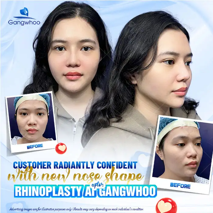 How Long Does a Synthetic Cartilage Rhinoplasty Last and When Should Follow-Up Be Scheduled?