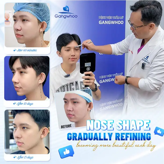 How Long Does a Synthetic Cartilage Rhinoplasty Last and When Should Follow-Up Be Scheduled?