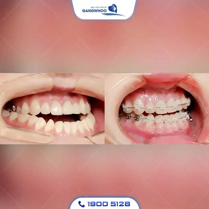 Dịch Vụ Chỉnh Nha Niềng Răng Chuẩn Hàn Quốc – Nụ Cười Đẹp Chuẩn Tại Gangwhoo