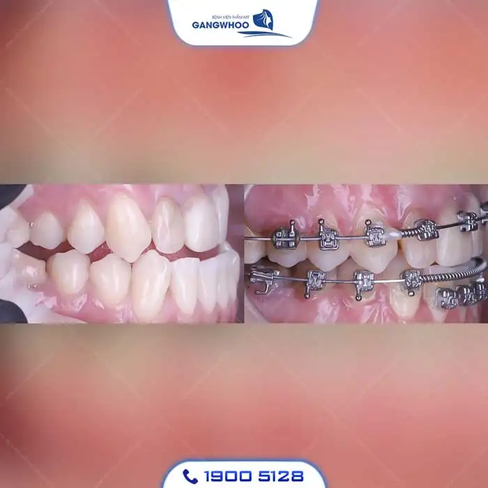 Dịch Vụ Chỉnh Nha Niềng Răng Chuẩn Hàn Quốc – Nụ Cười Đẹp Chuẩn Tại Gangwhoo