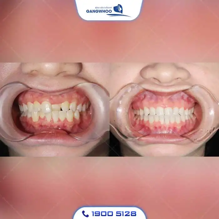 Dịch Vụ Chỉnh Nha Niềng Răng Chuẩn Hàn Quốc – Nụ Cười Đẹp Chuẩn Tại Gangwhoo