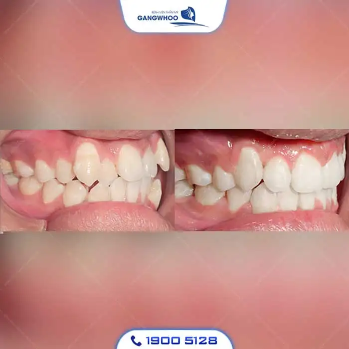 Dịch Vụ Chỉnh Nha Niềng Răng Chuẩn Hàn Quốc – Nụ Cười Đẹp Chuẩn Tại Gangwhoo