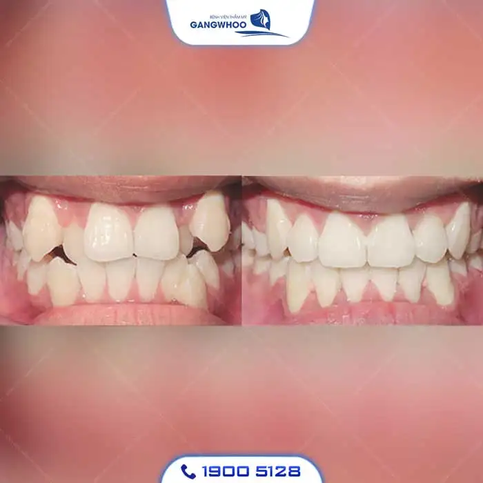 Dịch Vụ Chỉnh Nha Niềng Răng Chuẩn Hàn Quốc – Nụ Cười Đẹp Chuẩn Tại Gangwhoo