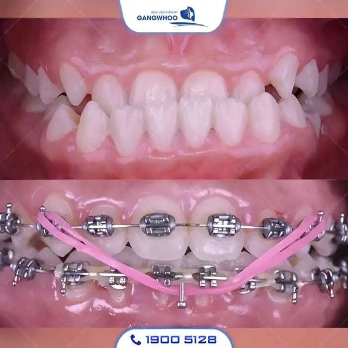 Dịch Vụ Chỉnh Nha Niềng Răng Chuẩn Hàn Quốc – Nụ Cười Đẹp Chuẩn Tại Gangwhoo