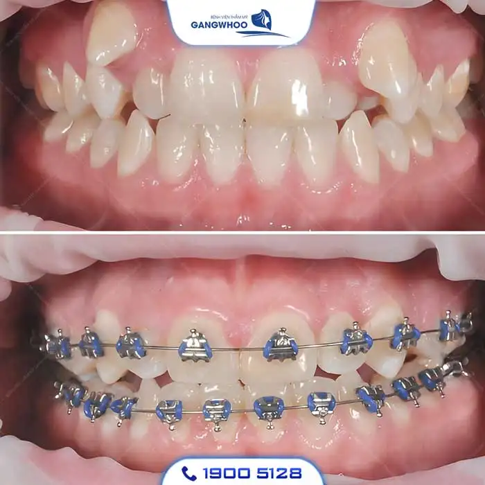Dịch Vụ Chỉnh Nha Niềng Răng Chuẩn Hàn Quốc – Nụ Cười Đẹp Chuẩn Tại Gangwhoo