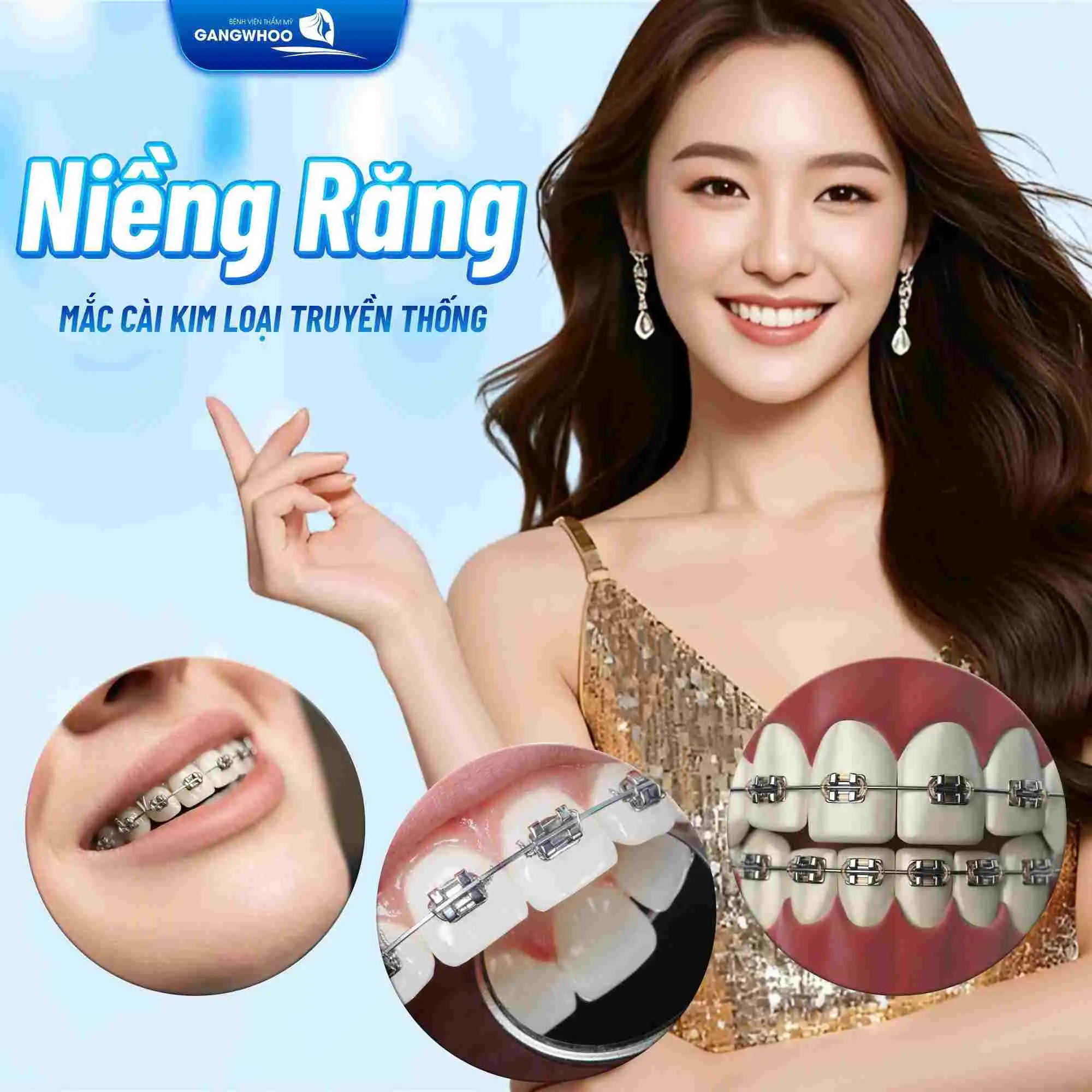 Niềng răng mắc cài kim loại truyền thống