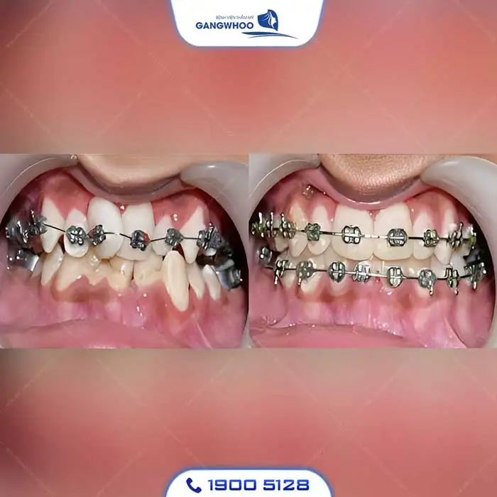 Dịch Vụ Chỉnh Nha Niềng Răng Chuẩn Hàn Quốc – Nụ Cười Đẹp Chuẩn Tại Gangwhoo