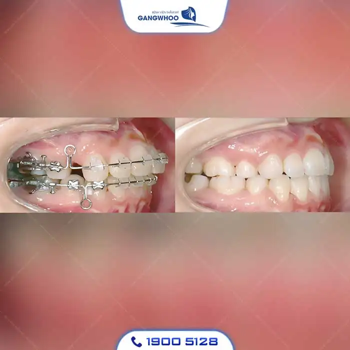 Dịch Vụ Chỉnh Nha Niềng Răng Chuẩn Hàn Quốc – Nụ Cười Đẹp Chuẩn Tại Gangwhoo