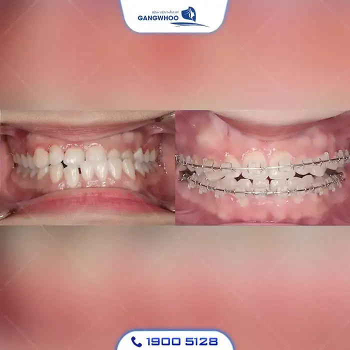 Dịch Vụ Chỉnh Nha Niềng Răng Chuẩn Hàn Quốc – Nụ Cười Đẹp Chuẩn Tại Gangwhoo
