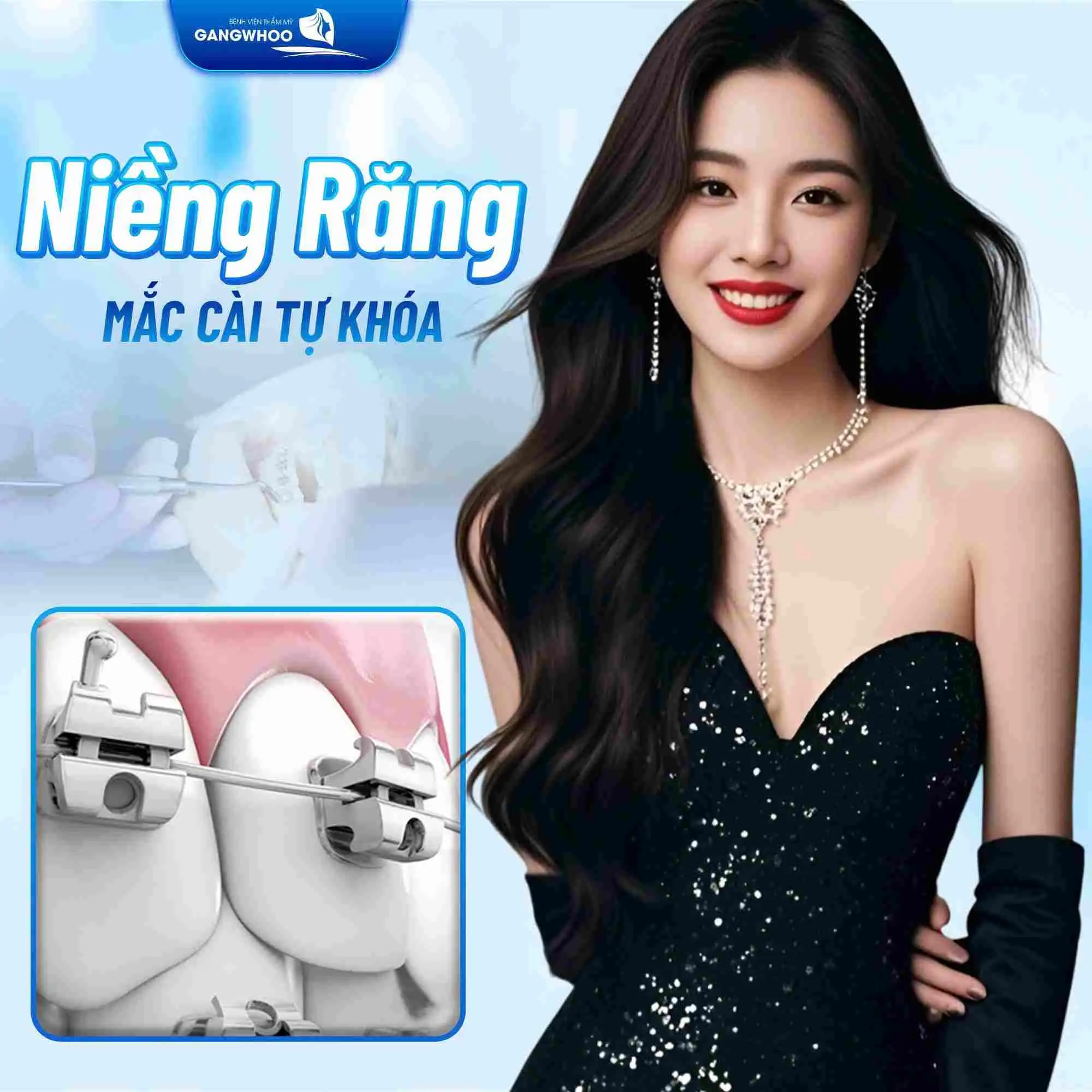Niềng răng mắc cài tự khóa