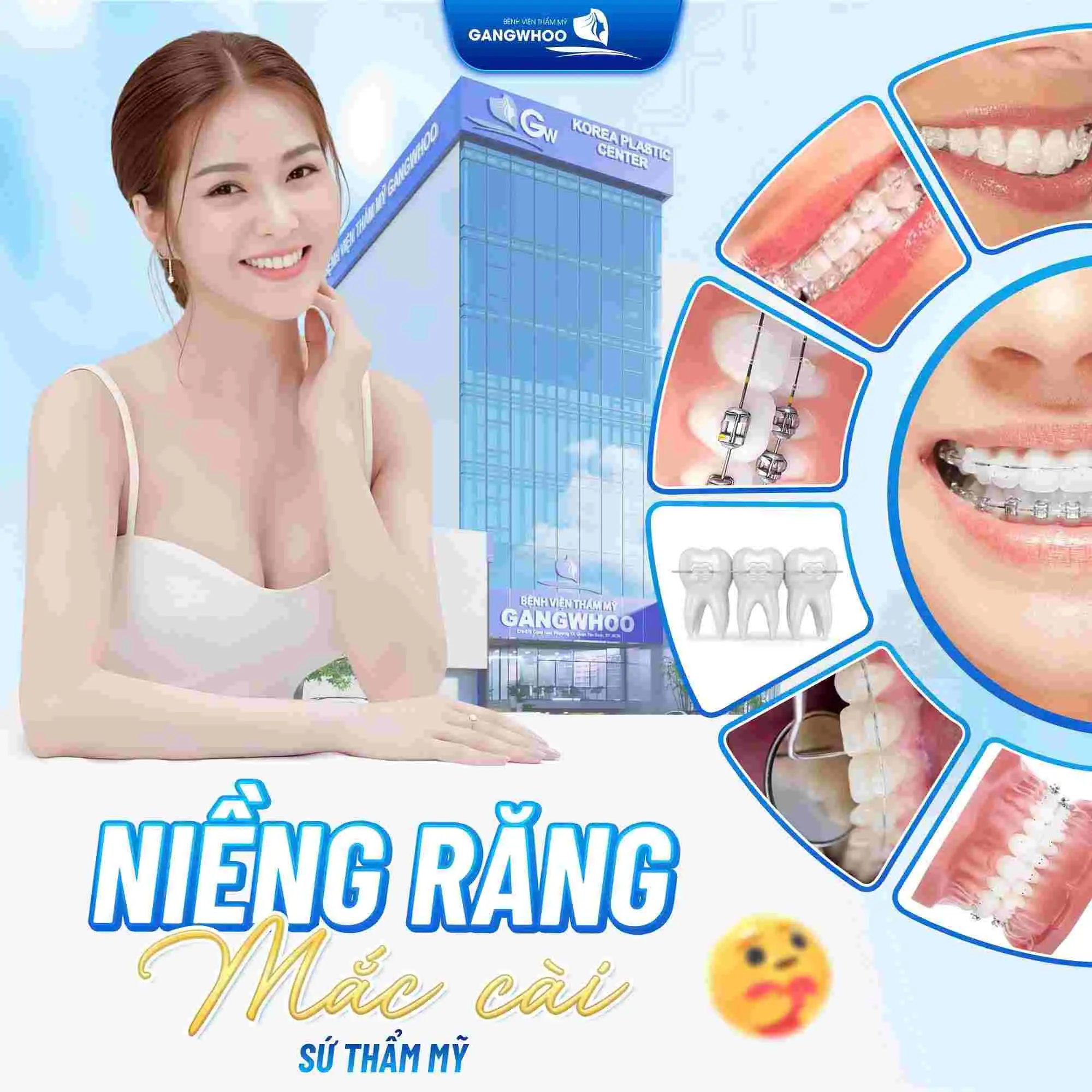 Niềng răng mắc cài sứ thẩm mỹ