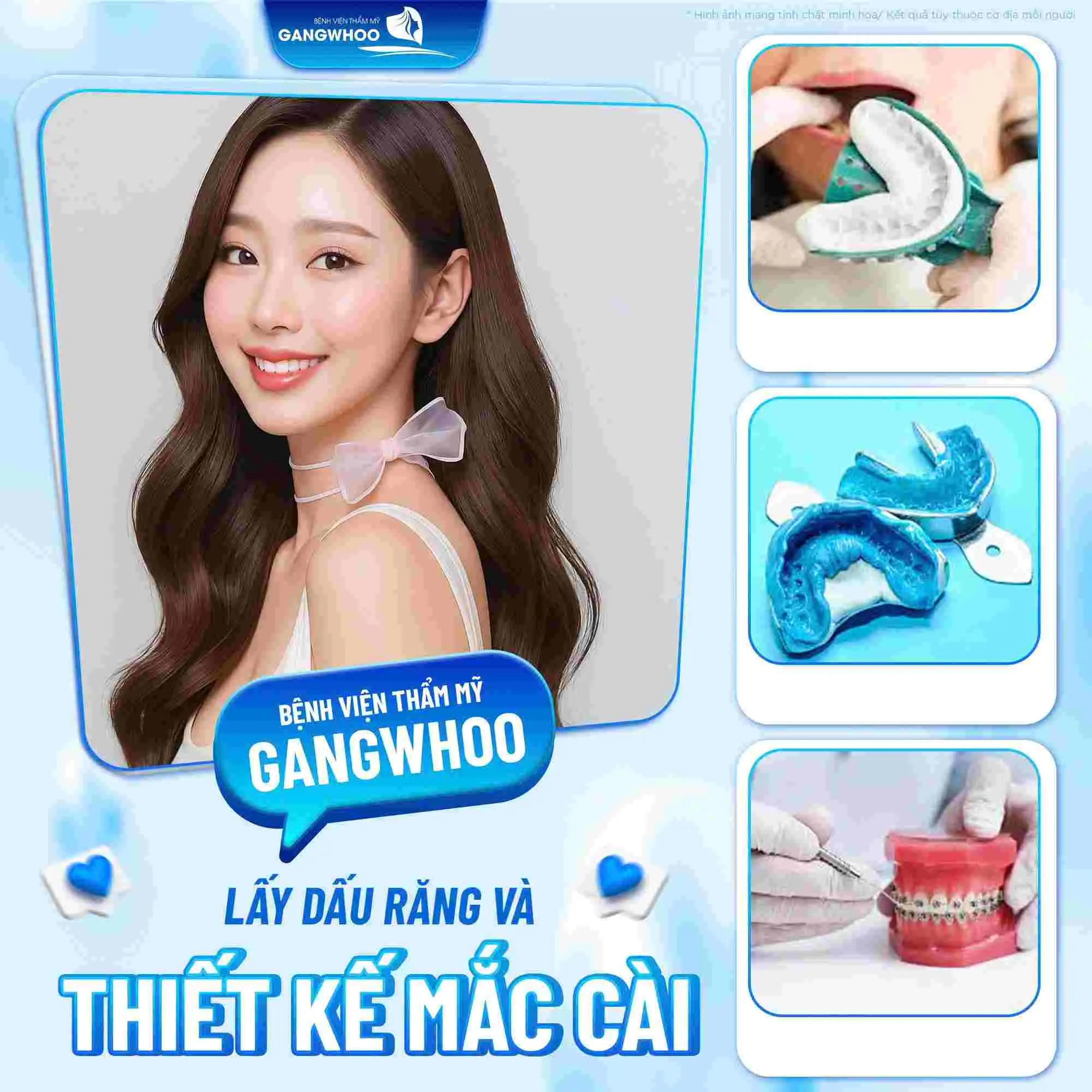 Lấy dấu hàm và thiết kế mắc cài